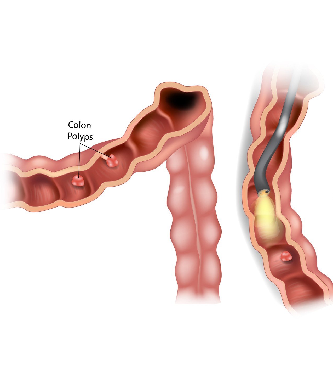 Colon polyps illustration