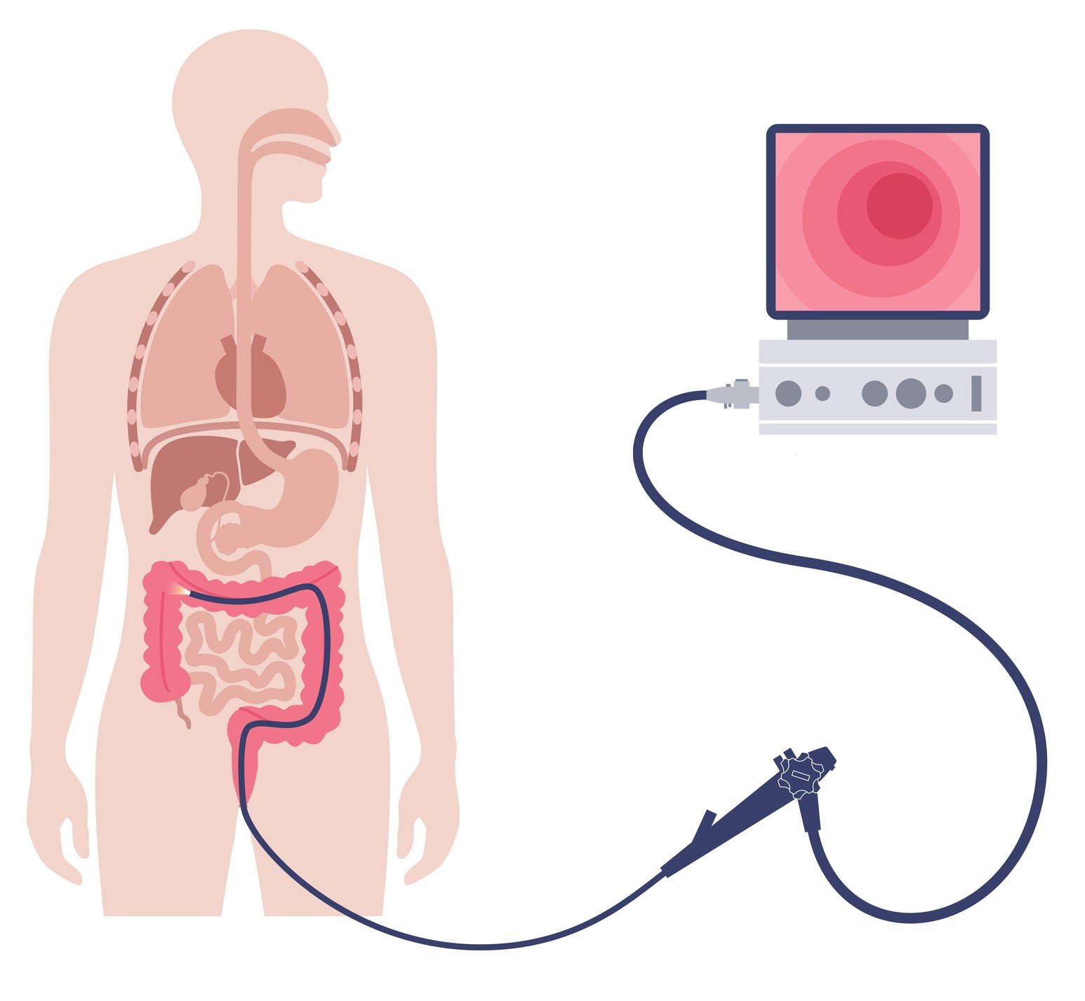Colonoscopy procedure illustration