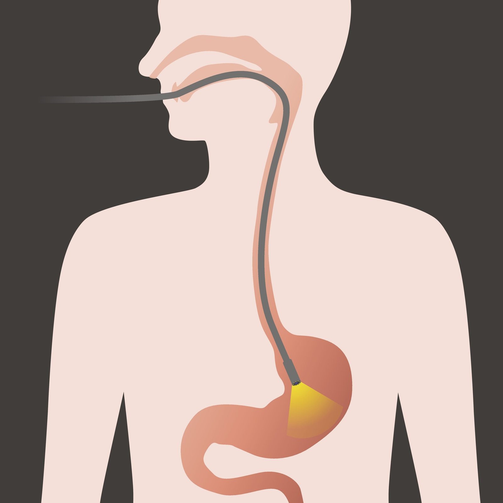 Gastroscopy procedure diagram showing endoscope inserted through mouth into stomach